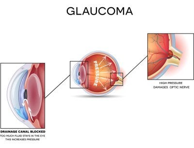 Risk Of Glaucoma